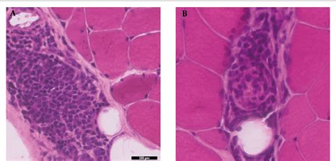 diana mnatsakanova|Neuromuscular Disease 